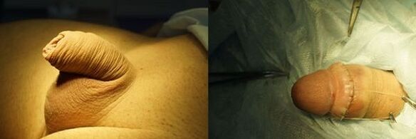 dzimumloceklis pirms un pēc palielināšanas operācijas