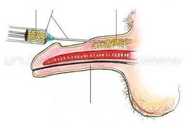injekcijas dzimumlocekļa paplašināšana